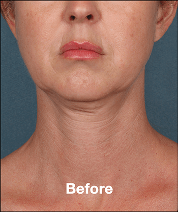 Kybella Before and After Pictures West Palm Beach, FL