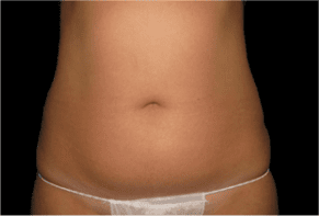 Liposuction Before and After Pictures West Palm Beach, FL