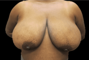 Breast Reduction Before and After Pictures West Palm Beach, FL