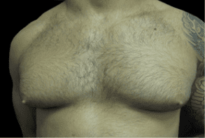 Gynecomastia Before and After Pictures West Palm Beach, FL