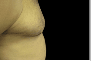 Gynecomastia Before and After Pictures West Palm Beach, FL