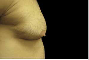 Gynecomastia Before and After Pictures West Palm Beach, FL