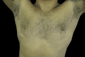 Gynecomastia Before and After Pictures West Palm Beach, FL