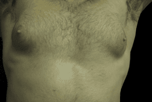 Gynecomastia Before and After Pictures West Palm Beach, FL