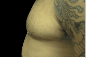 Gynecomastia Before and After Pictures West Palm Beach, FL