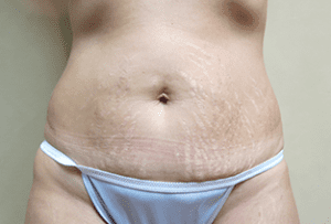 Abdominoplasty Before and After Pictures West Palm Beach, FL