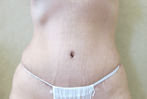 Abdominoplasty Before and After Pictures West Palm Beach, FL