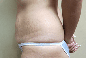 Abdominoplasty Before and After Pictures West Palm Beach, FL
