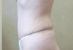 Abdominoplasty Before and After Pictures West Palm Beach, FL