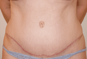 Abdominoplasty Before and After Pictures West Palm Beach, FL