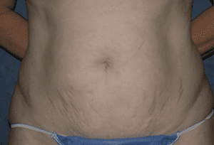 Abdominoplasty Before and After Pictures West Palm Beach, FL
