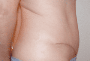 Abdominoplasty Before and After Pictures West Palm Beach, FL