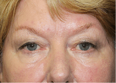 Blepharoplasty Before and After Pictures West Palm Beach, FL