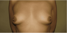 Breast Augmentation Before and After Pictures West Palm Beach, FL