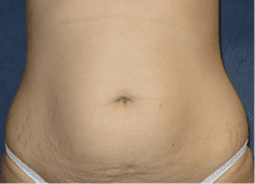 Abdominoplasty Before and After Pictures West Palm Beach, FL