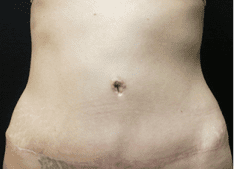 Abdominoplasty Before and After Pictures West Palm Beach, FL