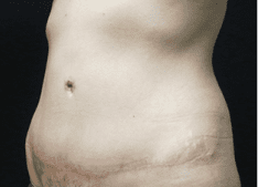 Abdominoplasty Before and After Pictures West Palm Beach, FL