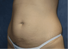 Abdominoplasty Before and After Pictures West Palm Beach, FL