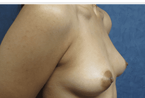 Breast Augmentation Before and After Pictures West Palm Beach, FL