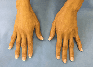 Radiesse Before and After Pictures West Palm Beach, FL