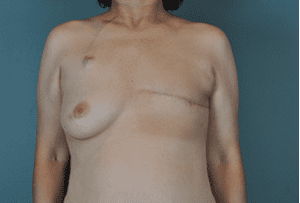 Breast Reconstruction Before and After Pictures West Palm Beach, FL