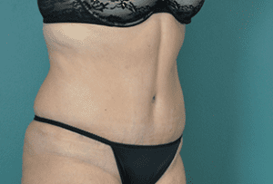 Tummy Tuck Before and After Pictures West Palm Beach, FL (Dr. Vinyard)