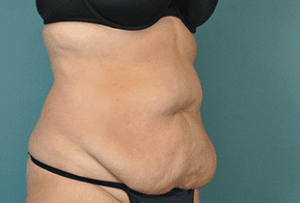 Tummy Tuck Before and After Pictures West Palm Beach, FL (Dr. Vinyard)
