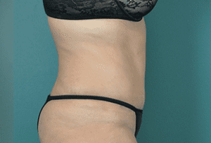 Tummy Tuck Before and After Pictures West Palm Beach, FL (Dr. Vinyard)