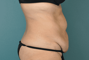 Tummy Tuck Before and After Pictures West Palm Beach, FL (Dr. Vinyard)