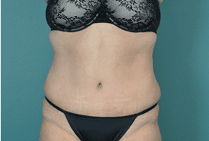 Tummy Tuck Before and After Pictures West Palm Beach, FL (Dr. Vinyard)