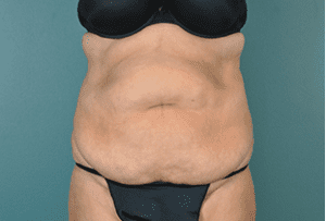 Tummy Tuck Before and After Pictures West Palm Beach, FL (Dr. Vinyard)