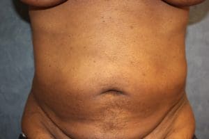 Liposuction Before and After Pictures West Palm Beach, FL