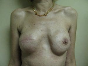 Breast Reconstruction Before and After Pictures West Palm Beach, FL