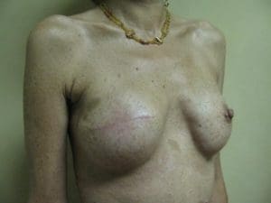 Breast Reconstruction Before and After Pictures West Palm Beach, FL