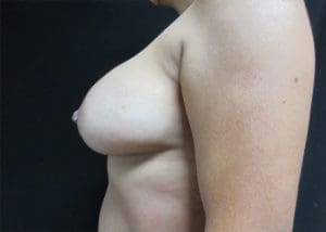 Breast Augmentation Before and After Pictures West Palm Beach, FL