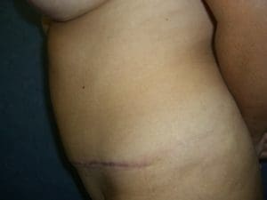 Breast Augmentation Before and After Pictures West Palm Beach, FL