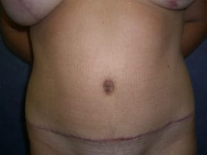 Mommy Makeover Before and After Pictures West Palm Beach, FL