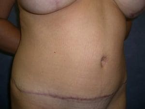 Breast Augmentation Before and After Pictures West Palm Beach, FL