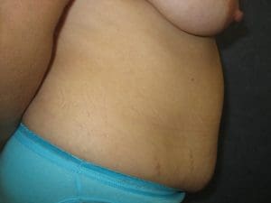 Breast Augmentation Before and After Pictures West Palm Beach, FL