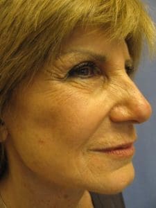 Facelift Before and After Pictures West Palm Beach, FL