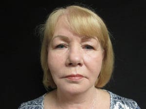 Facelift Before and After Pictures West Palm Beach, FL