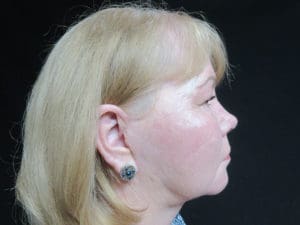 Facelift Before and After Pictures West Palm Beach, FL