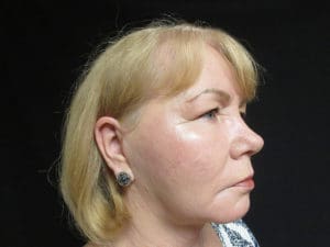 Facelift Before and After Pictures West Palm Beach, FL