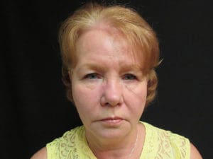 Facelift Before and After Pictures West Palm Beach, FL