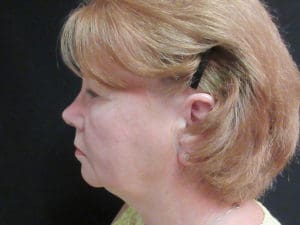 Facelift Before and After Pictures West Palm Beach, FL