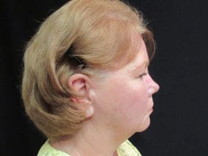 Facelift Before and After Pictures West Palm Beach, FL