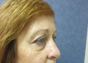 Blepharoplasty Before and After Pictures West Palm Beach, FL