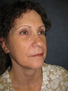 Facelift Before and After Pictures West Palm Beach, FL