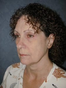 Facelift Before and After Pictures West Palm Beach, FL