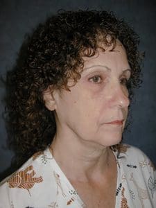 Facelift Before and After Pictures West Palm Beach, FL